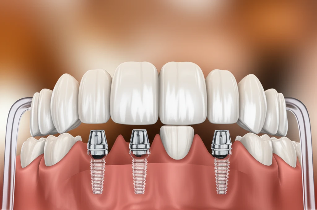 무치악 임플란트의 개념을 보여주는 이미지